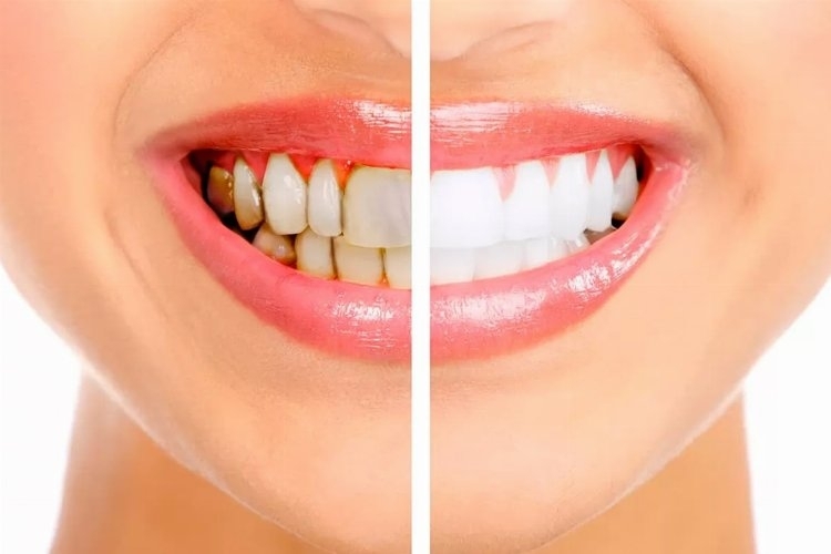 Periodontoloji Uzmanından Diş Taşı Oluşumu ve Tedavisi Hakkında Bilgilendirme